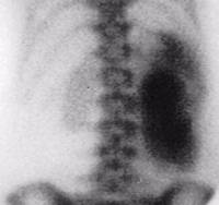 Urine Extravasation