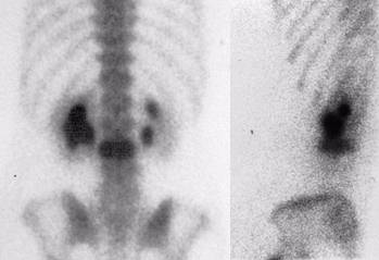 Horseshoue Kidney
