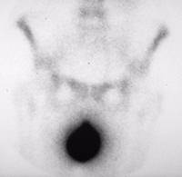 Bladder Prolapse