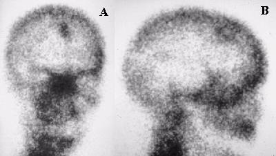 Dural Calcification