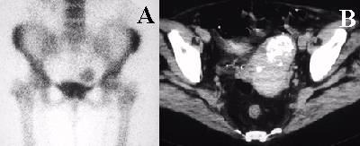 Calcified Fibroid