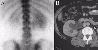 Hydronephrosis