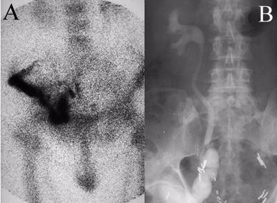 Ileal Conduit