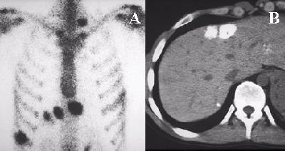 METASTATIC OSTEOSARCOMA