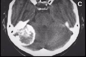 Meningioma CT