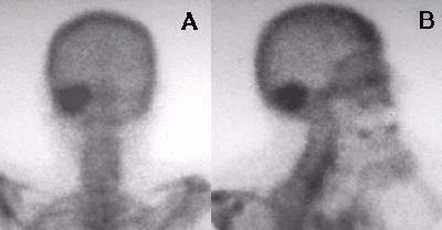 Meningioma