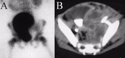 Pelvic Abscess