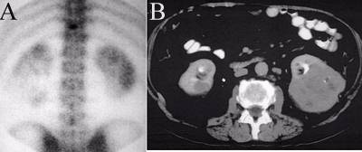 Renal Cell Carcinoma and Renal Cyst