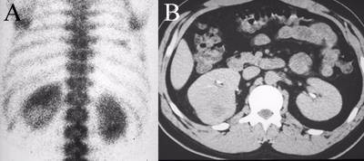 Renal Cell Carcinoma
