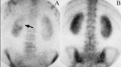 Gallstone