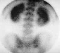 Hyperparathyroidism