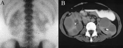 Lymphoma