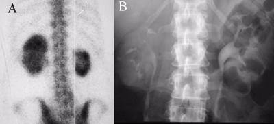 Chronic Pyelonephritis