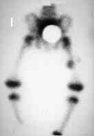 Metastatic Neuroblastoma