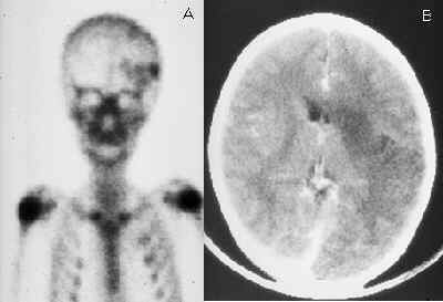 Cerebral Infarction