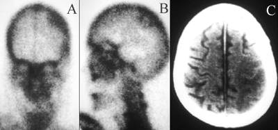 Cerebral infarction