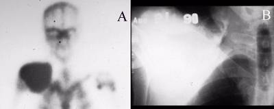 Metastatic Calcification